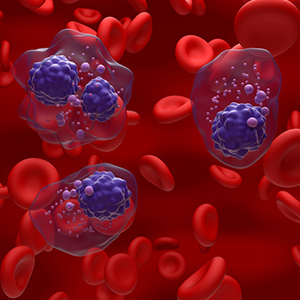 Multiple myeloma