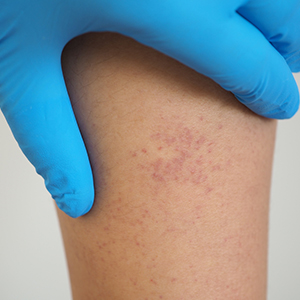 Thrombocytopenia