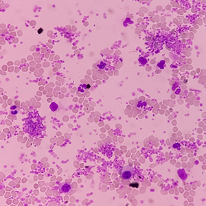 Thrombocytosis